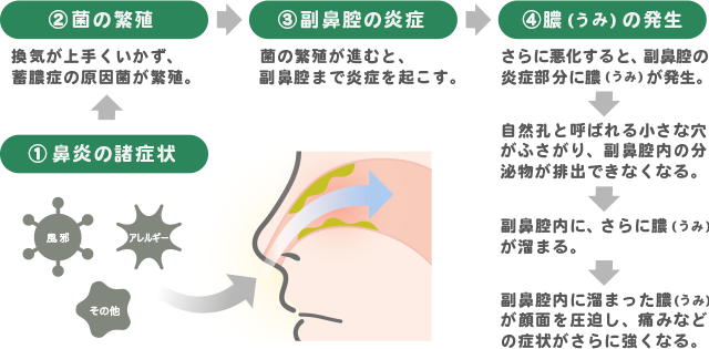 ちくのう症（副鼻腔炎）のイメージ図