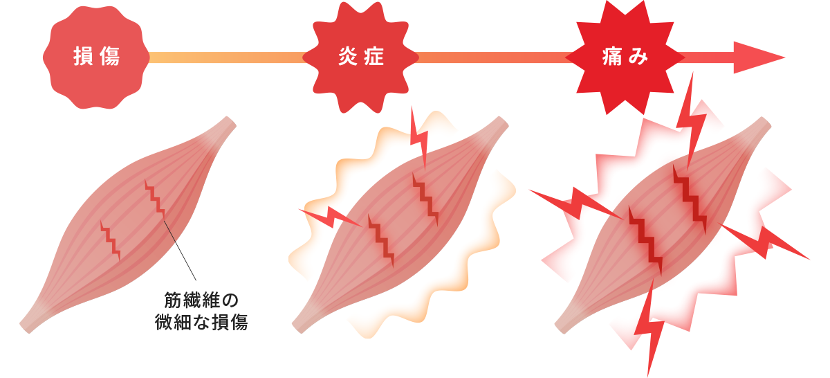 筋肉痛のメカニズム