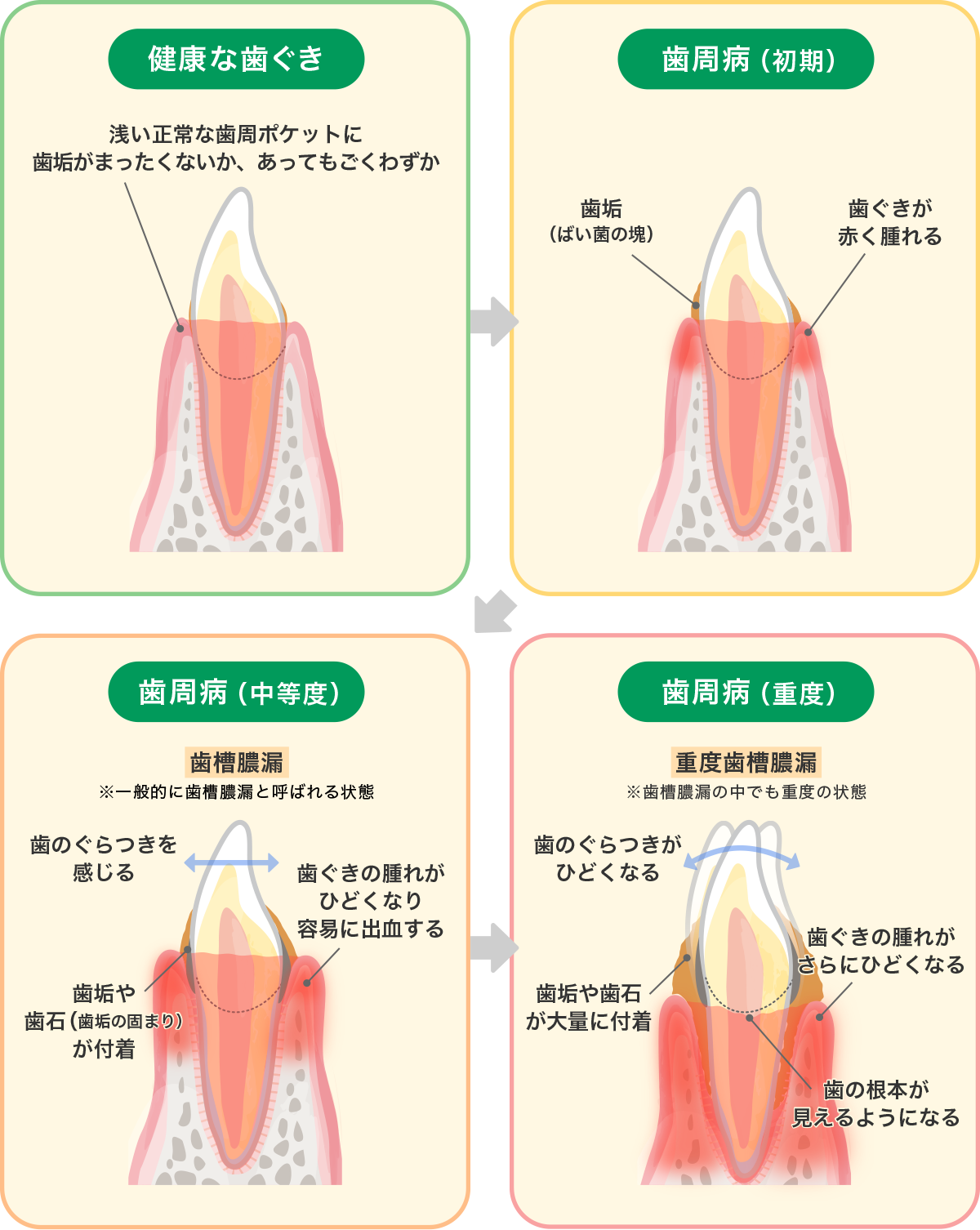 歯槽膿漏の進行