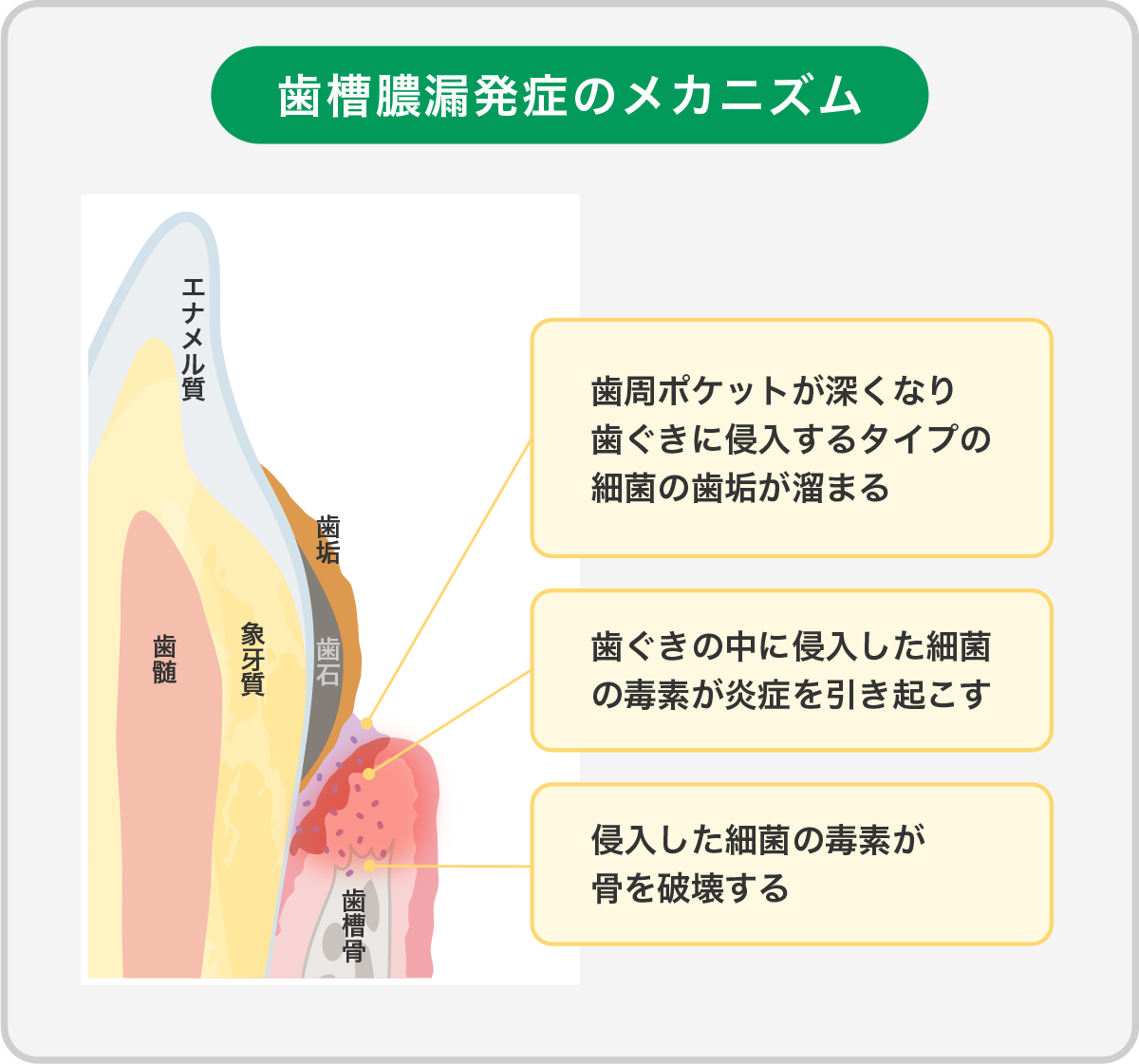歯槽膿漏の発症メカニズム